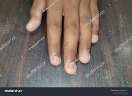 Image result for Onychotillomania feet