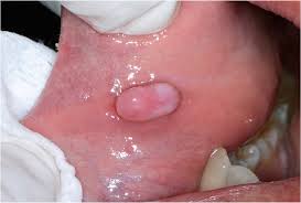 Image result for Labial mucosa