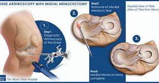 Admitted Knee Arthroscopy Orthopedics Orthopedic Surgery