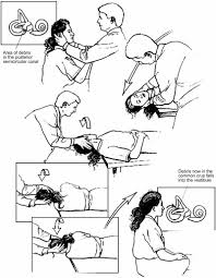 Image result for Canalith Repositioning Procedure