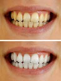 Zahnbleaching paket bleaching gel set zahnweiß zahnaufhellung weiße zähne. Professionelles Bleaching Beim Zahnarzt Danijel Bago Zahnarztpraxis In Meckenbeuren