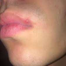 Ursache für pickel an der lippe. Komischer Punkt Auf Der Lippe Pickel Gesicht
