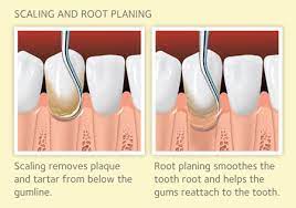 Maybe you would like to learn more about one of these? Scaling And Root Planing For Gum Disease American Dental Association