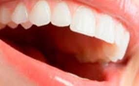 Damak Kasintisi Kasinmasi Nedenleri Damak Kasintisina Ne Iyi Gelir