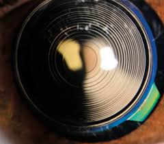 Tipuri de cristalin artificial pret. Cristalin Panoptix Pareri Cristalinul Trifocal Care Reda Vederea Clara