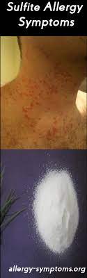 Sulfite Allergy Symptoms And Diagnosis Allergy Symptoms