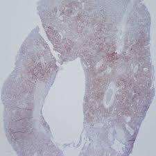 We did not find results for: Intramedullary Masses Of The Spinal Cord Radiologic Pathologic Correlation Radiographics
