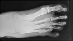 A Rare Case Of Closed Degloving Injury Of The Fifth Toe Sciencedirect