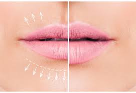Covergirl colorlicious lipstick in 265 romance mauve. Lip Fillers Vs Fotona Liplase What S The Difference Dr Tanja Phillips