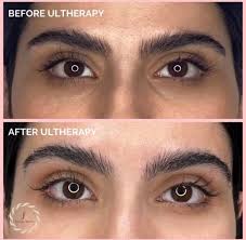 Ultherapy