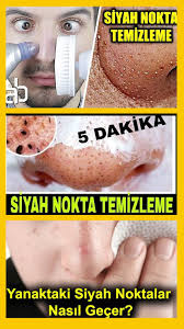 Yuzdeki Siyah Noktalar Nasil Temizlenir