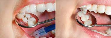 The cost of a filling depends on whether you have dental insurance, the complexity of the filling, your. Average Cost Of Tooth Filling How Much Tooth Filing Cost In Los Angeles