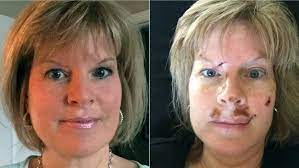 The pimple also may go away. Skin Cancer Melanoma Warning Signs You Should Never Ignore