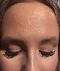 I Have Lots Of Milia I Think On My Forehead And Between My Eyes How Do I Get Rid Of Them Howtogetrid Forehead Acne Forehead Bumps Small Bumps On Forehead
