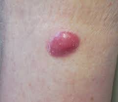 This could be due to other non cancerous skin conditions. Skin Cancer Information The Skin Cancer Foundation