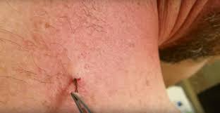 Ingrown hairs are an unfortunately common side effect of trying to. Ingrown Hair On The Vagina Ex Girlfriend Photos