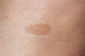 They are evenly colored round patches that range in size from 1 to 2 mm to greater than 20 cm in greatest diameter. Neurofibromatosis Type 1 Symptoms And Treatment