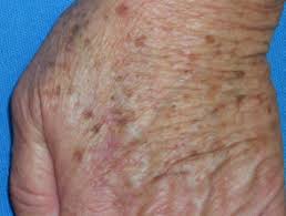 Find out more about how this surgery is this page will give you information about removing benign skin lesions. Common Benign Skin Lesions Dermnet Nz