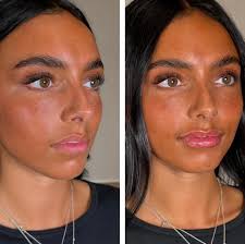 A little enhancement for this pretty woman 🤍✨ 📍 RO Aesthetics 3775 South  Highland Drive, Suite 2 Salt Lake City, UT 84106 📞 Questions or anything  you need: Call/Text 801-233-8778 💻 To