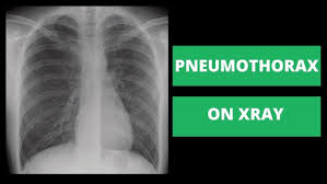 Image result for Pneumothorax