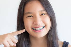 Straightening your teeth at home without braces. Is It Possible To Make Your Teeth Straight Without Braces