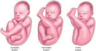Breech Delivery In The Emergency Department Springerlink
