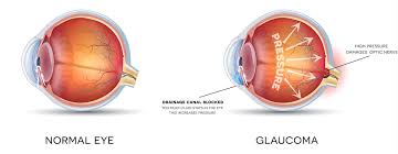 Image result for Glaucoma