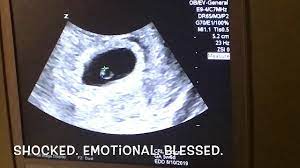 6 weeks ultrasound twinspictures will also confirm that you are undeniably carrying two babies. 6 Week Ultrasound Are We Having Twins Youtube