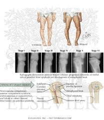 24 Blounts Ideas Disease Bow Legged Correction Knock Knees