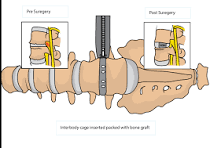 Minimally Invasive Oblique Lumbar Interbody Fusion (OLIF ...