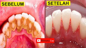 Cara Menghilangkan Karang Gigi Dalam 5 Menit Tanpa Harus Ke Dokter Gigi Youtube