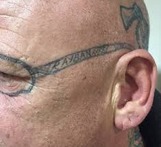 This can lead to either hyperpigmentation (skin darkening) or hypopigmentation (skin lightening). Laser Tattoo Removal Skin Resus