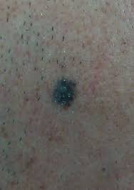 Image result for Blue Nevus