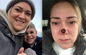 It has been known for quite some time that sun exposure is definitely the most common risk factor for skin cancer. Harmless Spot On Mum S Nose Turned Out To Be Skin Cancer