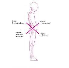 Lower Cross Syndrome Physiospain Physiotherapy Osteopathic Treatment In Fuengirola Mijas Malaga