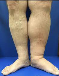 Treatment For May Thurner Syndrome Vein Specialists Of The Carolinas