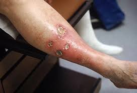 Image result for liver spots on legs