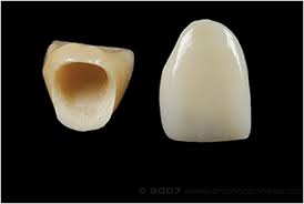 Resultado de imagen para protesis dental fija corona
