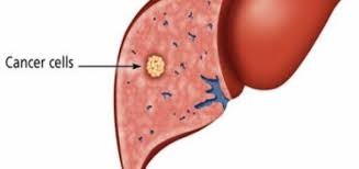 Each year in the united states, about 24,000 men and 10,000 women get liver cancer, and about 18,000 men and 9,000 what are the symptoms of liver cancer? Liver Cancer Hepatocellular Carcinoma Types Causes Symptoms And Signs Science Online