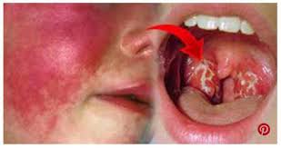 Si trasmette per via aerea ed è trattata efficacemente tramite la somministrazione di antibiotici. Scarlattina Sintomi Trattamento E Prevenzione Di Questa Malattia