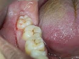 This Is The Most Important Thing You Can Do To Relieve Wisdom Tooth Pain
