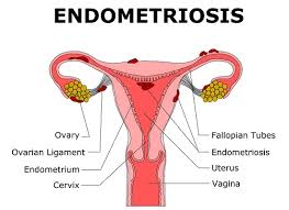 Information on endometriosis awareness week, a worldwide week event which runs from the 3rd of march to the 9th of march 2021. Endometriosis Awareness Month