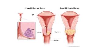 Check spelling or type a new query. Kanker Serviks Adi Husada Cancer Center Ahcc