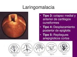 When the baby takes a breath, the part of the larynx above the vocal cords falls in and temporarily blocks the baby's airway. Estridor Y Laringitis Obstructiva Ppt Descargar