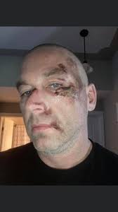 Mountain Biking Crash Experiences and Safety