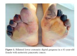 What does cancer look like in a dog? Catastrophic Arteriovenous Thromboembolism As Initial Manifestation Of Pancreatic Cancer Insight Medical Publishing