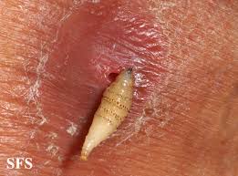 Looking for online definition of myasis in the medical dictionary? Myiasis Wikidoc