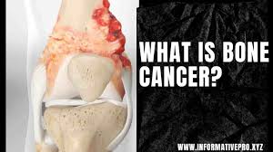 It will be easy to see if your bone is deteriorating because of the cancer. What Happens In Bone Cancer