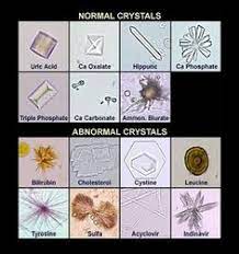 Si vous êtes sujet aux calculs d'oxalate de. 96 Idees De Cristaux Urinaires Cristaux Analyse Medicale Technologie Medicale