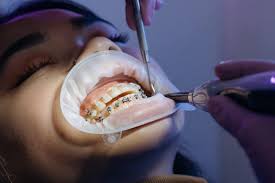 Merci de me répondre vite, je veux savoir comment bien prendre soin de mon appareil dentaire comme ca, j'éviterais de le garder plus. Appareil Dentaire Conseils En 2021 Pour Soulager La Douleur